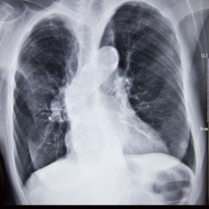 chronic bronchitis x-ray