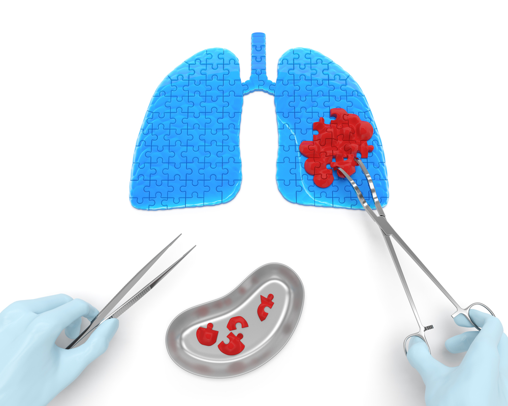 New Scoring System for Lung Cancer Diagnostic Test