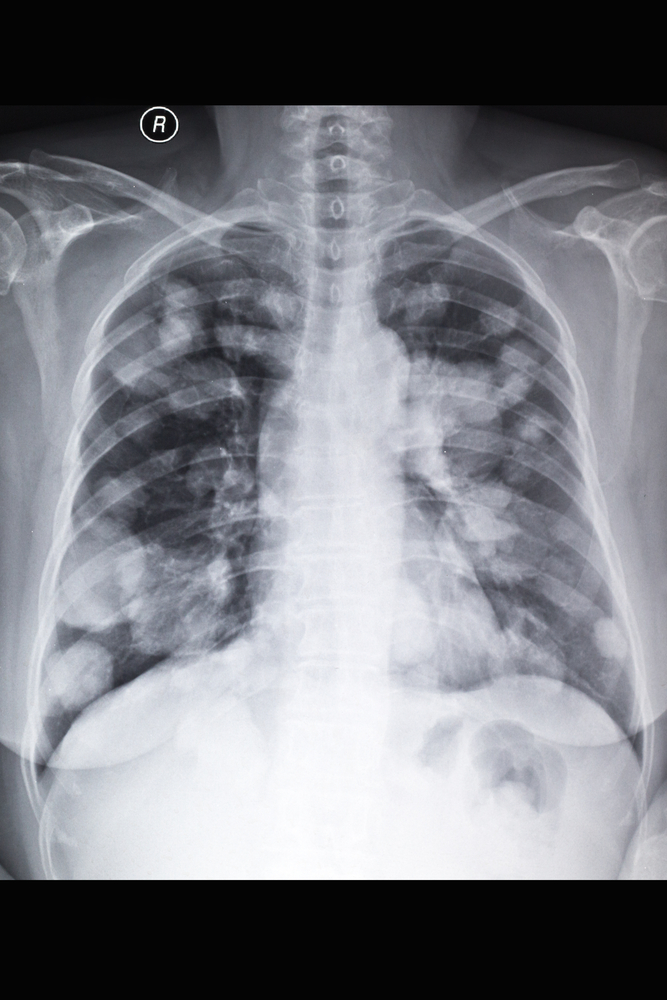 Benefit of Portrazza on NSCLC Is Minor, Limited to Certain